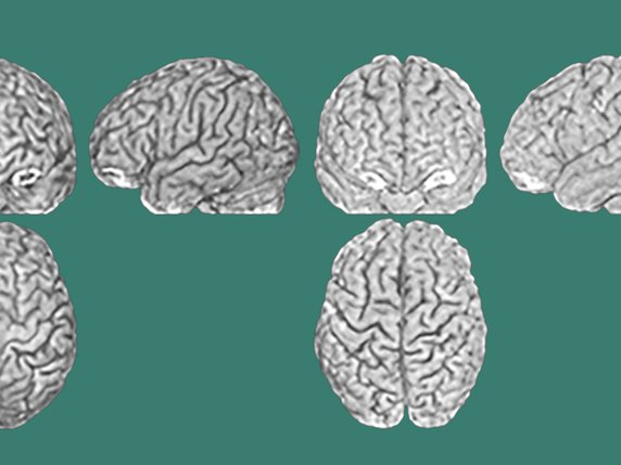 A gauche et à droite, trois scanners cérébraux de jumeaux: sillons et circonvolutions sont différents. © Lutz Jäncke/UZH