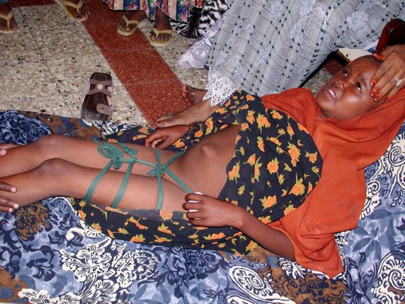 Amnesty International avait mis en avant le cas d'excision de cette jeune fille de neuf ans en Somalie pour rappeler que de telles mutilations sont malheureusement encore trop fréquentes (photo symbolique). © KEYSTONE/EPA/ULRIKE KOTERMANN