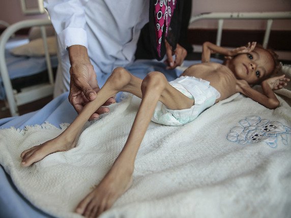Le Yémen est le théâtre de la pire crise humanitaire au monde, rappelle régulièrement l'ONU, qui précise que 14 millions de civils sont en situation de pré-famine (archives). © KEYSTONE/AP/HANI MOHAMMED