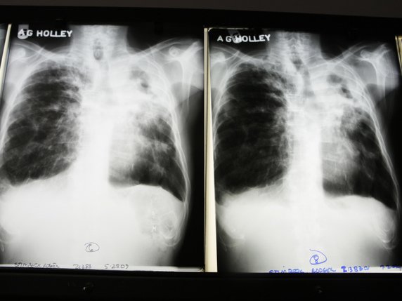 La tuberculose est une infection pulmonaire grave, qui se transmet par voie aérienne et qui peut se propager au cerveau (archives). © KEYSTONE/AP/Lynne Sladky