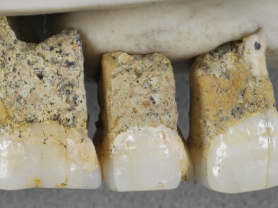 Au niveau des dents: les prémolaires d'Homo luzonensis (les premières sur l'image) présentent des ressemblances avec celles des Australopithèques. En revanche, les molaires (les deux suivantes) sont très petites et leur morphologie très simple ressemble à celle des hommes modernes. © KEYSTONE/AP Callao Cave Archaeology Project