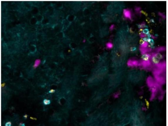 Cette image montre une coloration des lymphocytes T (cyan) exprimant la chimiokine CCL5 (jaune), une protéine qui appelle les cellules auto-réactives. Celles-ci se concentrent à l'endroit d'une ancienne infection virale (rose) contractée durant l'enfance. © UNIGE/Doron Merkler