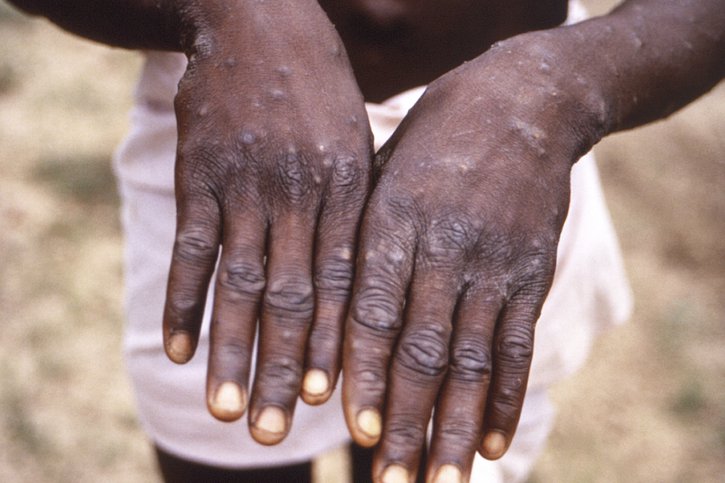 Il n'existe pas de traitement pour la variole du singe, qui guérit en général spontanément et dont les symptômes durent de 14 à 21 jours (archives). © KEYSTONE/AP